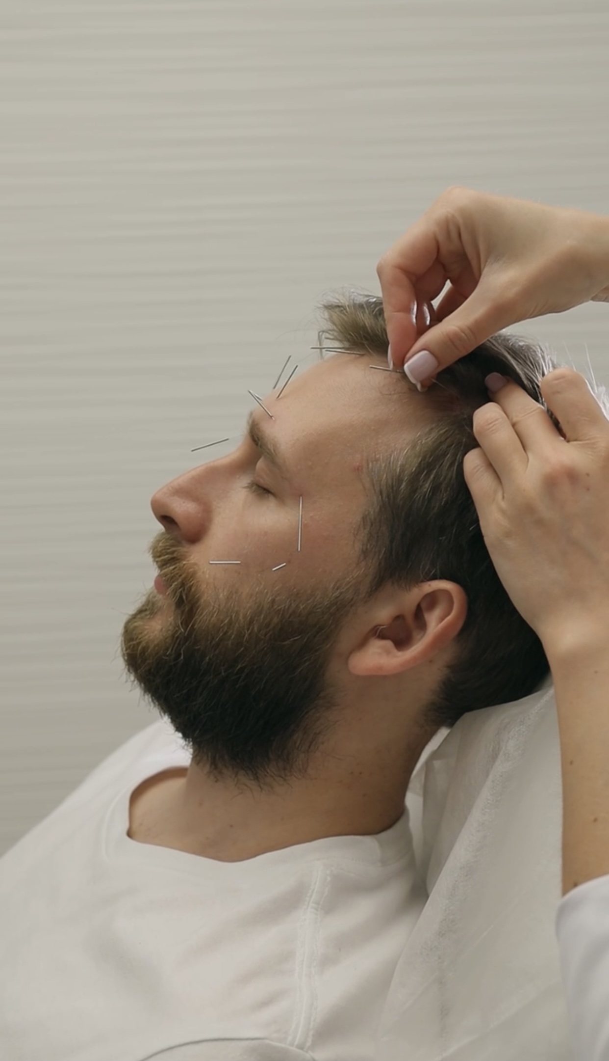 Иглотерапия: как работает популярная восточная процедура для лица (фото 4)