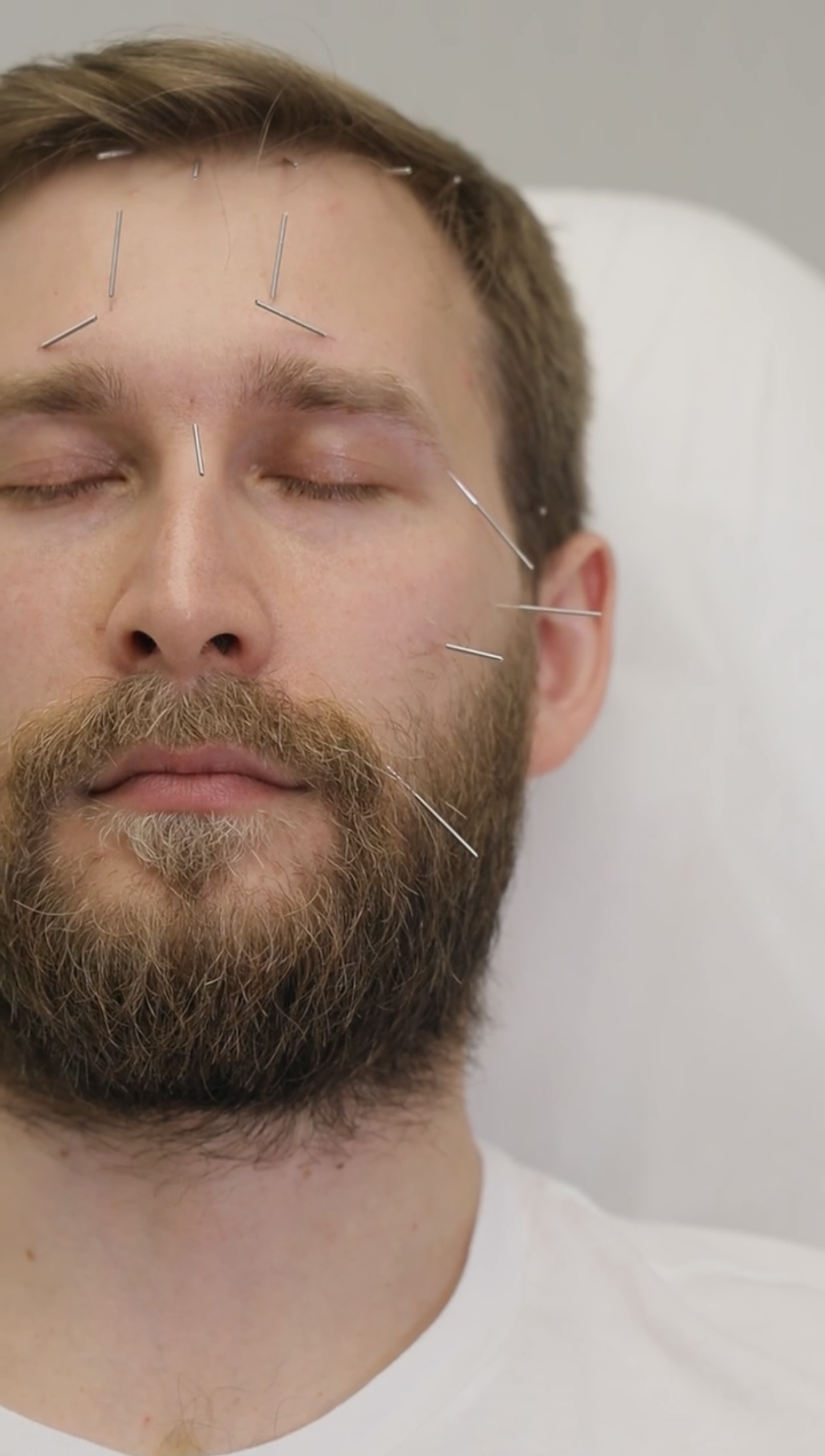 Иглотерапия: как работает популярная восточная процедура для лица (фото 3)