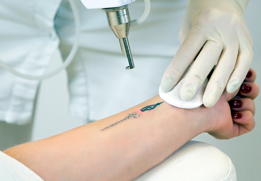 Как безопасно и эффективно свести татуировку? Отвечает специалист (фото 2)