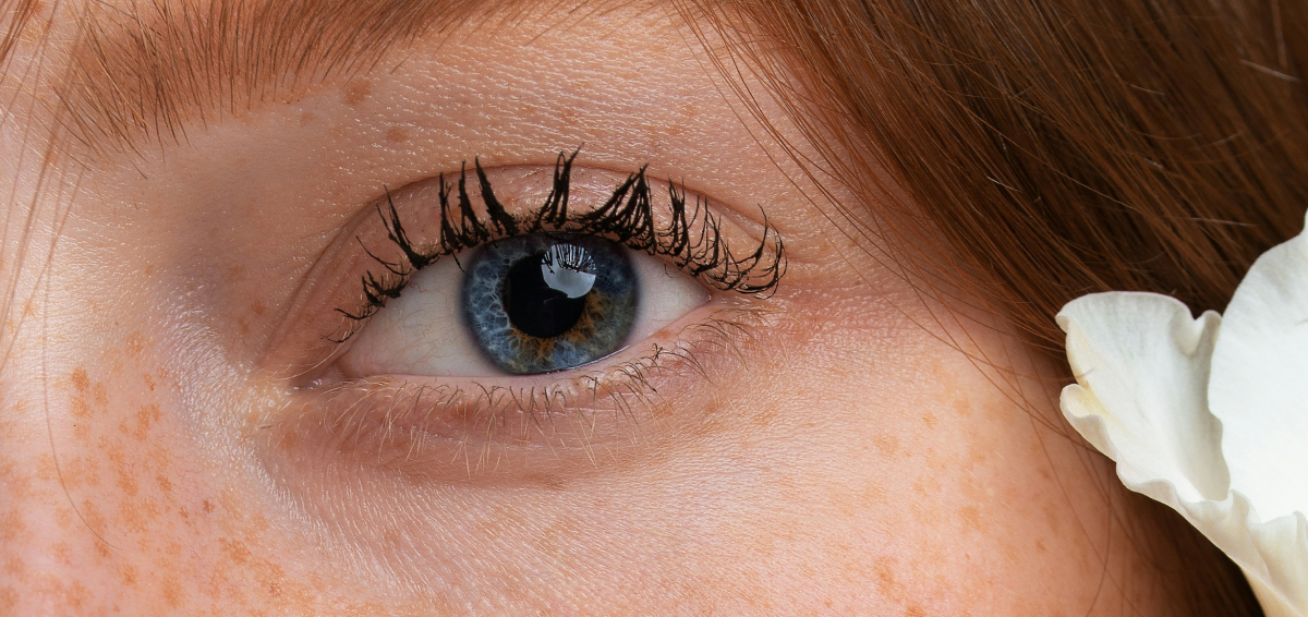 Веснушки и пигментация: почему появляются и как избавиться? Отвечает ...