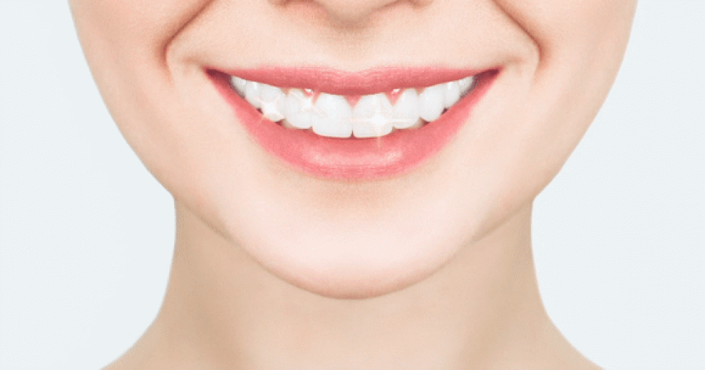 Отбеливание зубов: мифы и реальность