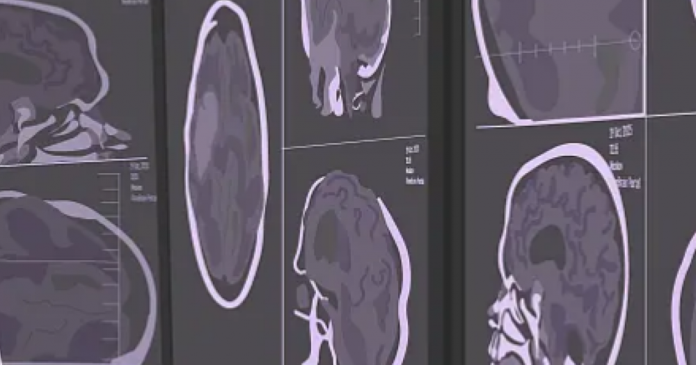 Фонд Хабенского перезапустил портал об опухолях мозга Oncobrain