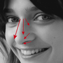 Мнение эксперта о популярной процедуре: безоперационная ринопластика