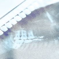 Я только спросить: как работает лазерное лечение десен и почему стоит выбрать именно его?