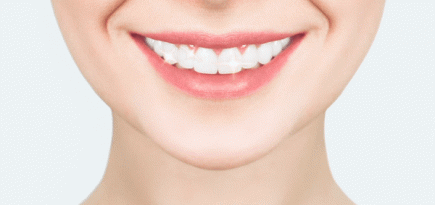 Отбеливание зубов: мифы и реальность