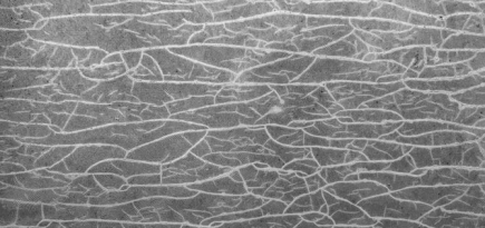 Как формируется целлюлит и почему кремы не работают