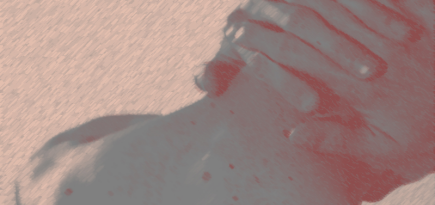 Акне ниже шеи: как избавиться от воспалений на теле? Отвечает эксперт