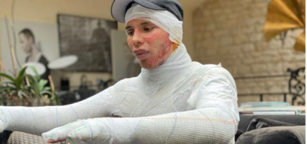 Оливье Рустен рассказал, что серьезно пострадал при взрыве камина в доме