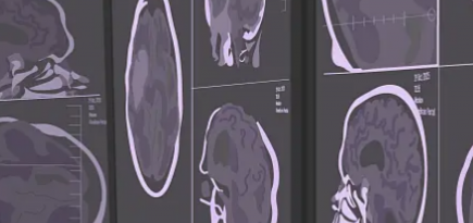 Фонд Хабенского перезапустил портал об опухолях мозга Oncobrain