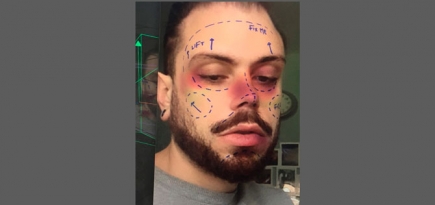 Instagram запретил фильтры с эффектом пластической хирургии