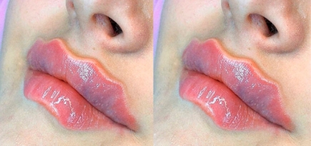 В инстаграме обсуждают тренд на губы-осьминоги