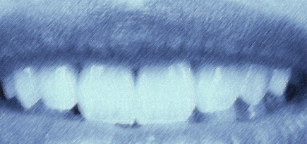 Я только спросить: что такое бруксизм и как перестать скрежетать зубами?