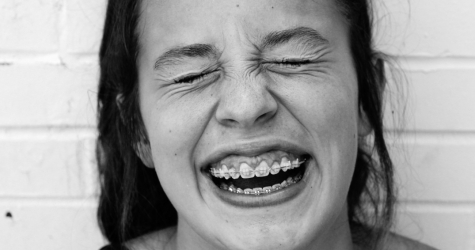 Все, что нужно знать о брекетах: 7 вопросов стоматологу