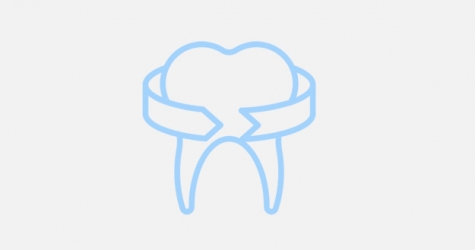 Что нужно знать о винирах