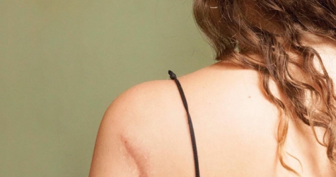 Facebook заблокировал группу, где выкладывали фотографии моделей со шрамами