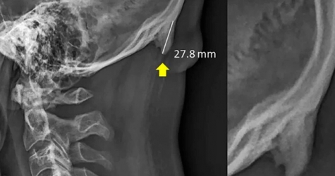 Ученые исправили исследование о появлении рога на затылке из-за смартфонов