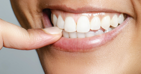 5 фактов о винирах, которые нужно знать до их установки