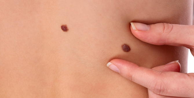 La Roche-Posay проведет День диагностики меланомы в России