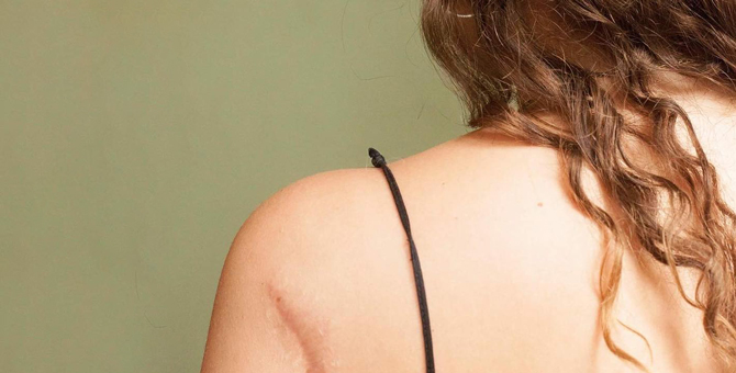 Facebook заблокировал группу, где выкладывали фотографии моделей со шрамами