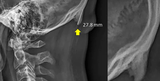 Ученые исправили исследование о появлении рога на затылке из-за смартфонов
