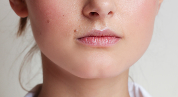 Что нужно знать о нитевом лифтинге